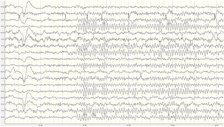 Eyes-open to eyes-closed EEG transition showing alpha response and blocking